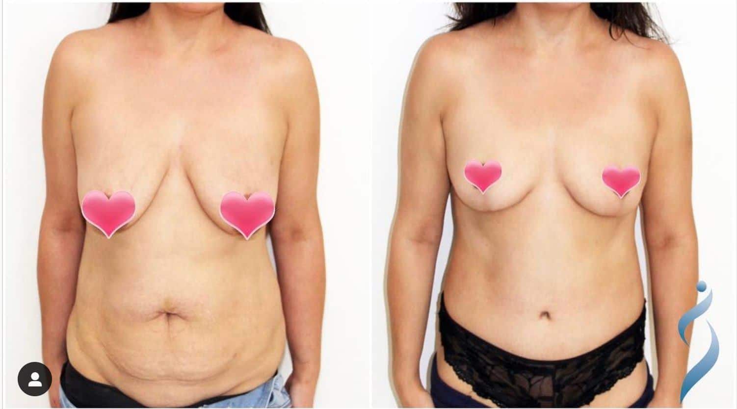 before and after tummy tuck dr siciliano hickory nc