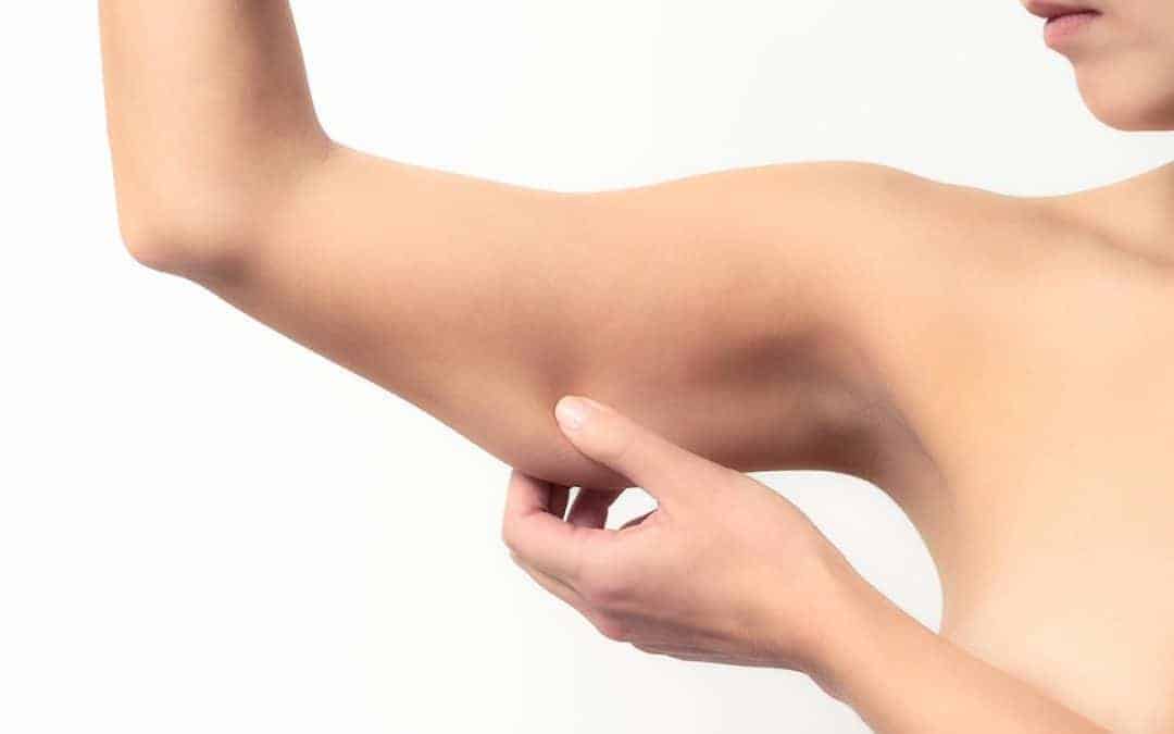 Arm Lift (Brachioplasty)